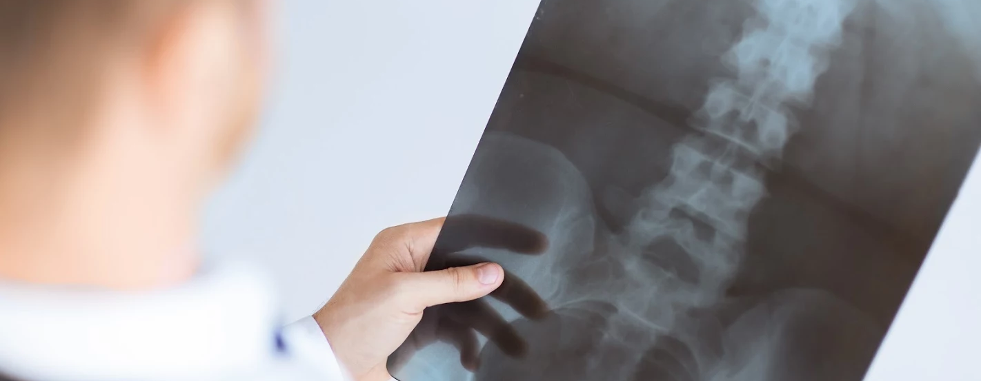 spinal cord injury x-ray : Spinal cord injury lawyer