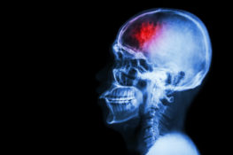 traumatic brain injury x-ray