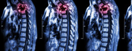 spinal cord injury xray